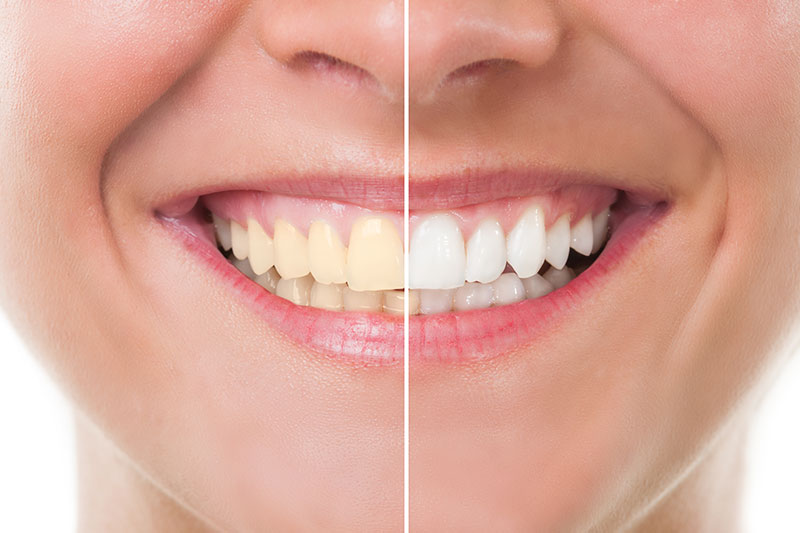Teeth Whitening in South Riding